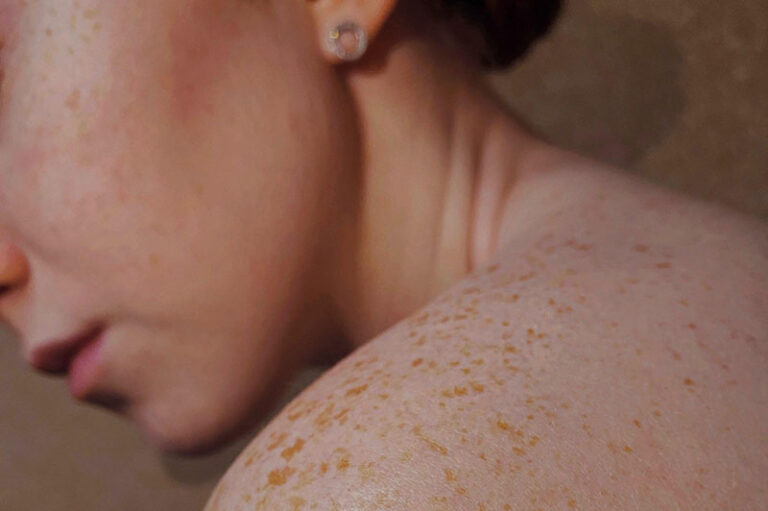 Skin Health Expert | The IBS Nutritionist Central London